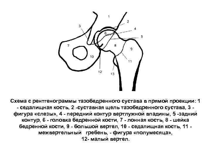 Схема с рентгенограммы тазобедренного сустава в прямой проекции: 1 седалищная кость, 2 суставная щель