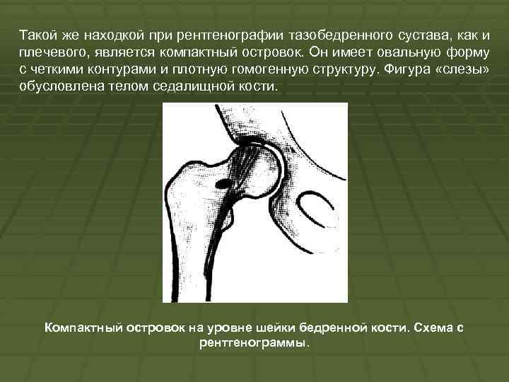 Такой же находкой при рентгенографии тазобедренного сустава, как и плечевого, является компактный островок. Он