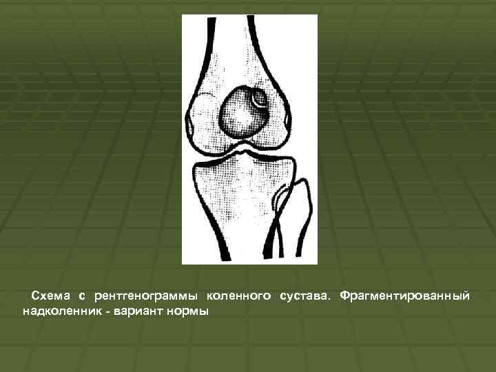 Схема с рентгенограммы коленного сустава. Фрагментированный надколенник вариант нормы 