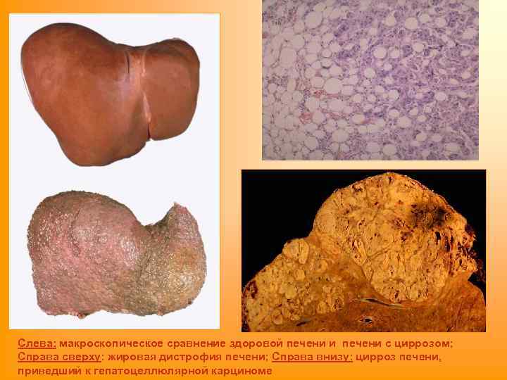 Слева: макроскопическое сравнение здоровой печени и печени с циррозом; Справа сверху: жировая дистрофия печени;