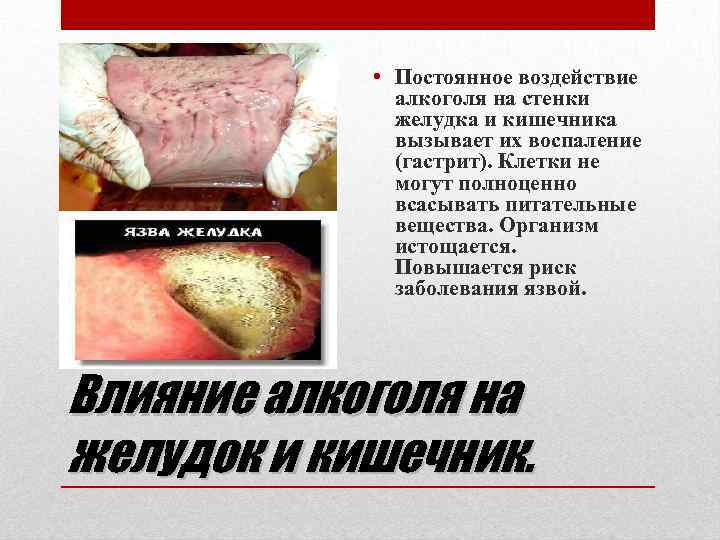  • Постоянное воздействие алкоголя на стенки желудка и кишечника вызывает их воспаление (гастрит).