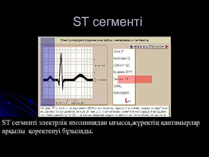 ST сегменті электрлік изолиниядан ығысса, жүректің қантамырлар арқылы қоректенуі бұзылады. 