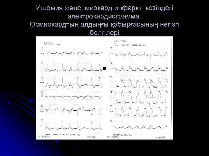 Ишемия және миокард инфаркт кезіндегі электрокардиограмма. Осмиокардтың алдыңғы қабырғасының негізгі белгілері 