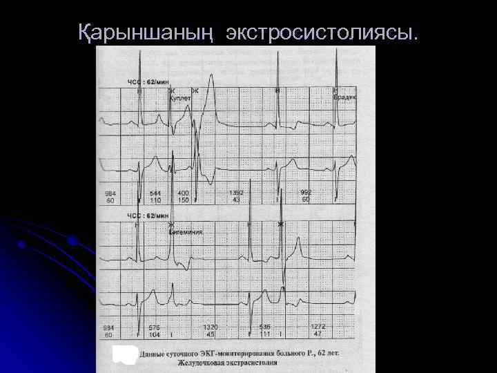 Қарыншаның экстросистолиясы. 