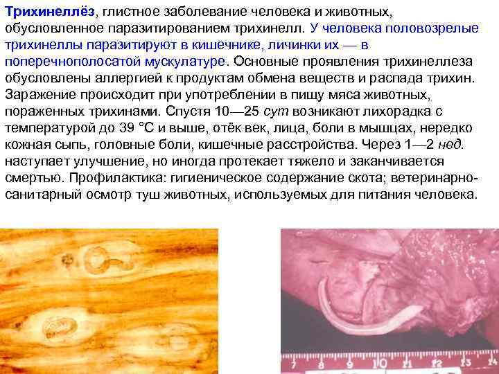 Трихинеллёз, глистное заболевание человека и животных, обусловленное паразитированием трихинелл. У человека половозрелые трихинеллы паразитируют