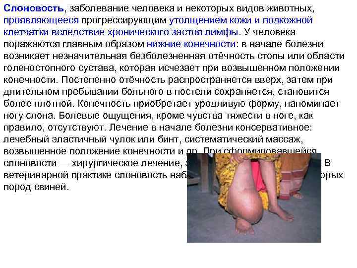 Слоновость, заболевание человека и некоторых видов животных, проявляющееся прогрессирующим утолщением кожи и подкожной клетчатки