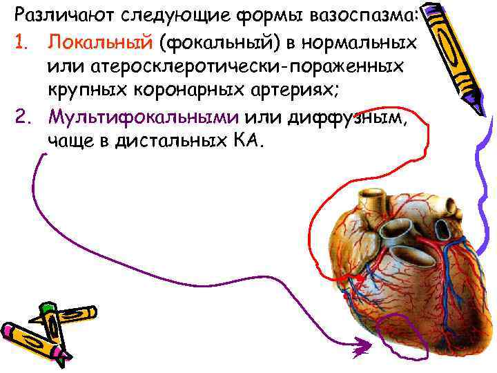 Различают следующие формы вазоспазма: 1. Локальный (фокальный) в нормальных или атеросклеротически-пораженных крупных коронарных артериях;