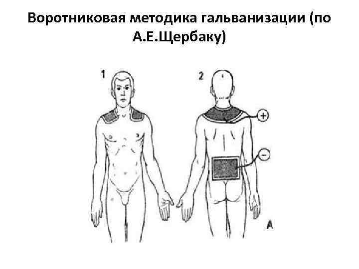 Воротниковая методика гальванизации (по А. Е. Щербаку) 