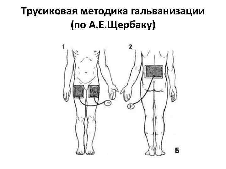 Трусиковая методика гальванизации (по А. Е. Щербаку) 