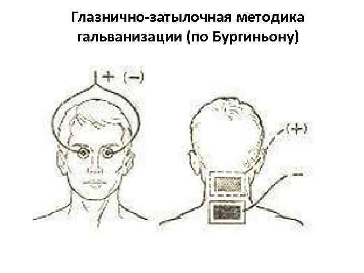 Глазнично-затылочная методика гальванизации (по Бургиньону) 