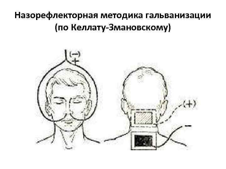 Назорефлекторная методика гальванизации (по Келлату-Змановскому) 