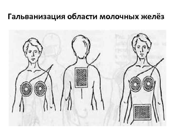 Гальванизация области молочных желёз 