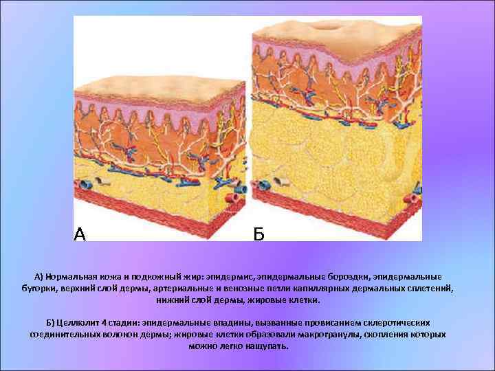 А) Нормальная кожа и подкожный жир: эпидермис, эпидермальные бороздки, эпидермальные бугорки, верхний слой дермы,