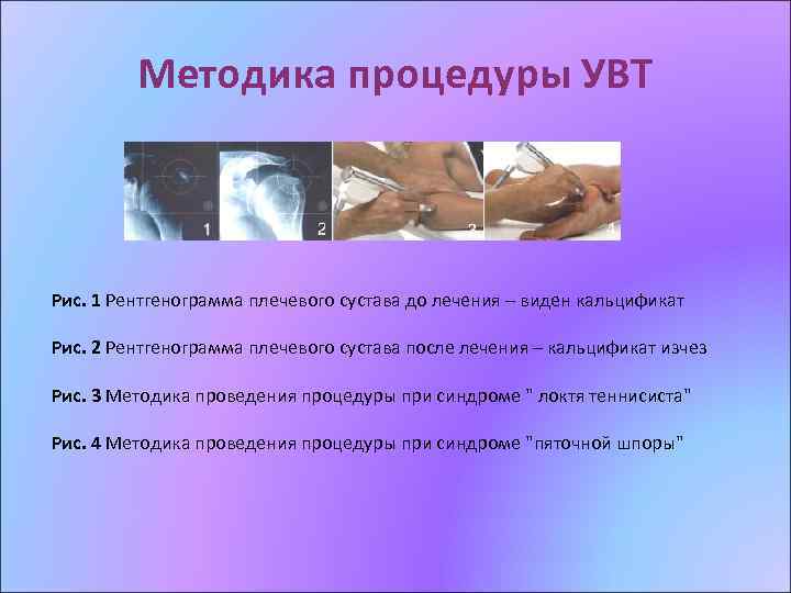 Методика процедуры УВТ Рис. 1 Рентгенограмма плечевого сустава до лечения – виден кальцификат Рис.