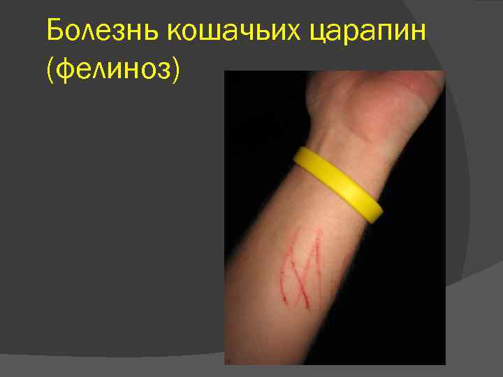 Болезнь кошачьих царапин (фелиноз) 