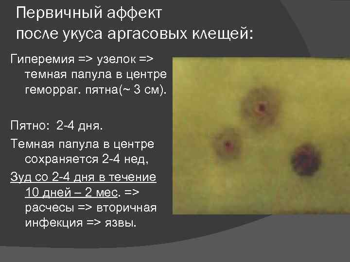 Первичный аффект после укуса аргасовых клещей: Гиперемия => узелок => темная папула в центре