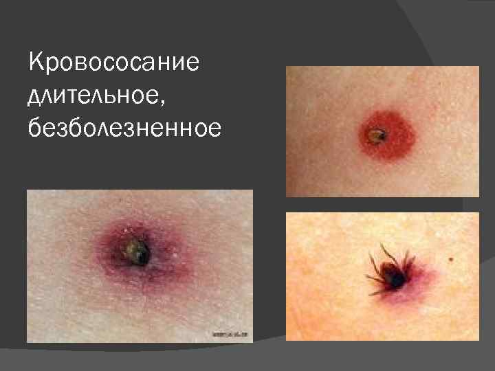 Кровососание длительное, безболезненное 