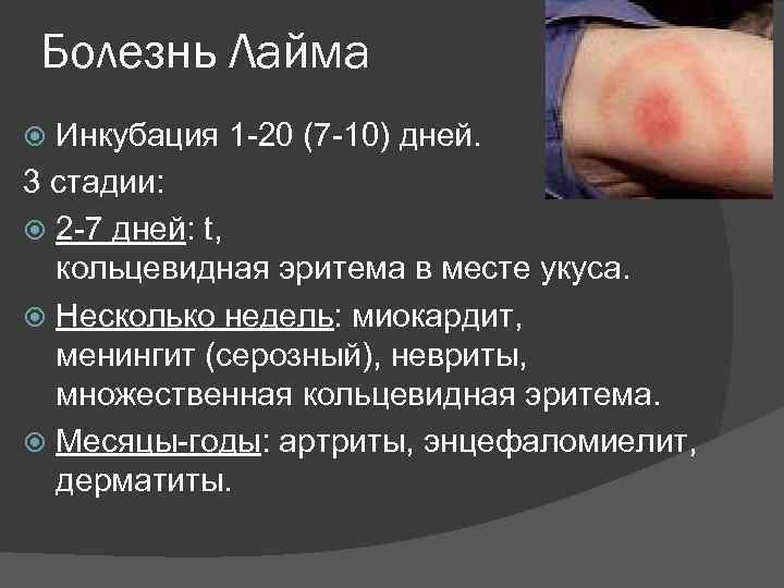 Болезнь Лайма Инкубация 1 -20 (7 -10) дней. 3 стадии: 2 -7 дней: t,