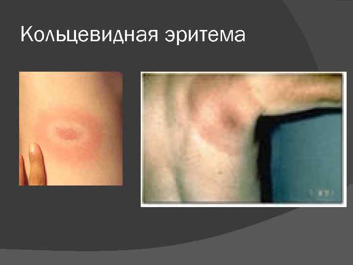 Кольцевидная эритема 