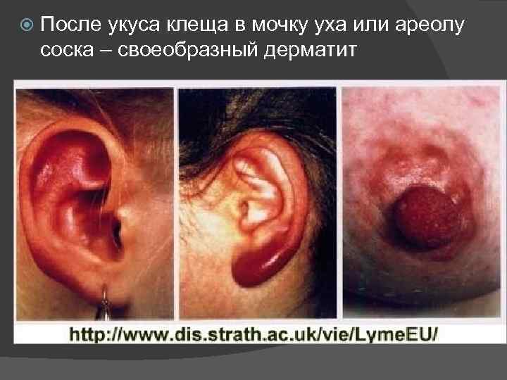 После укуса клеща в мочку уха или ареолу соска – своеобразный дерматит 