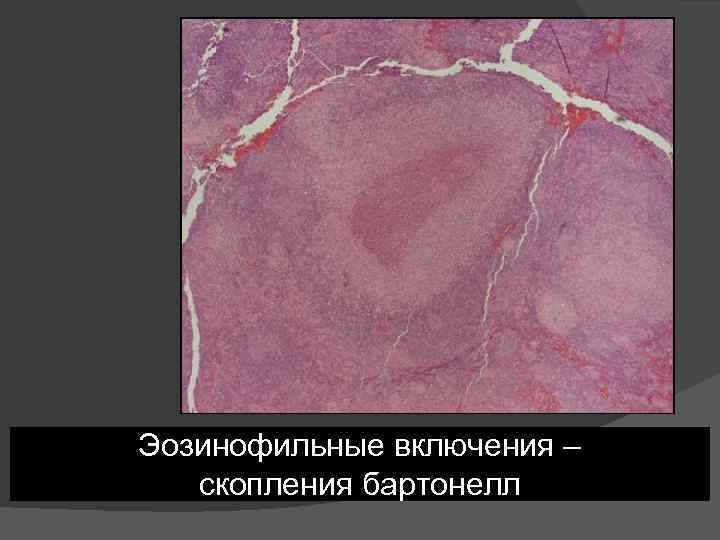 Эозинофильные включения – скопления бартонелл 