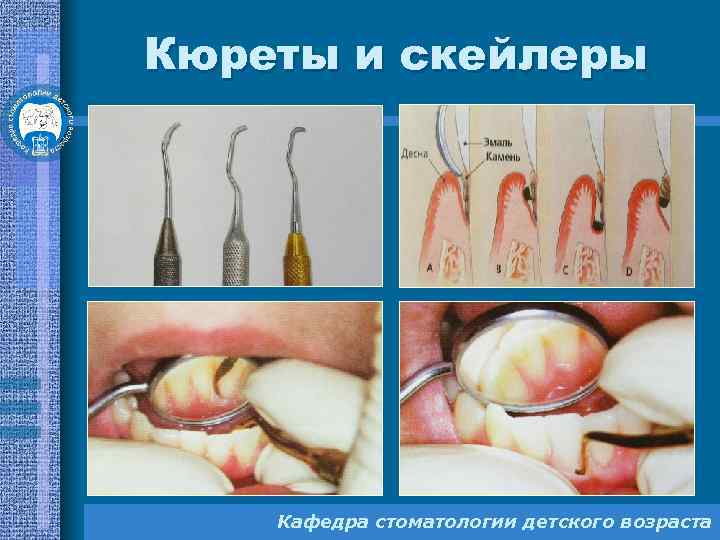 Кюреты и скейлеры Кафедра стоматологии детского возраста 