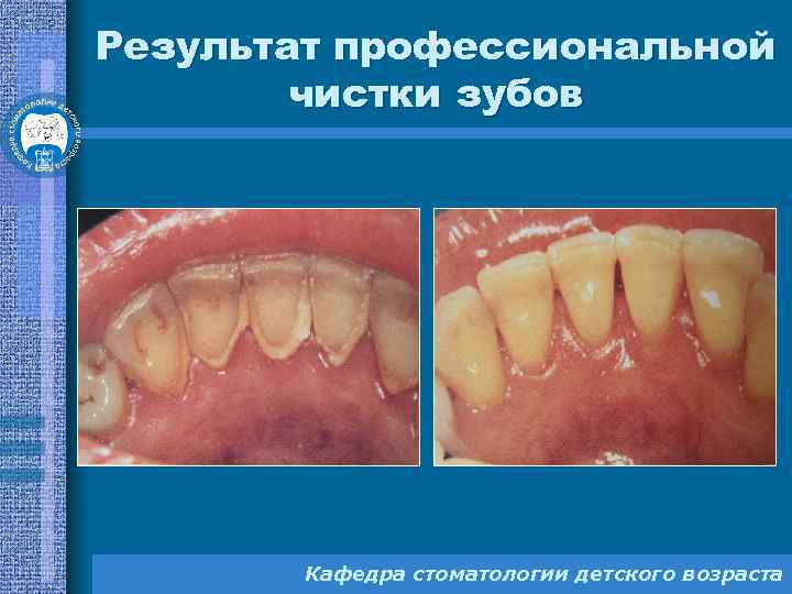 Результат профессиональной чистки зубов Кафедра стоматологии детского возраста 