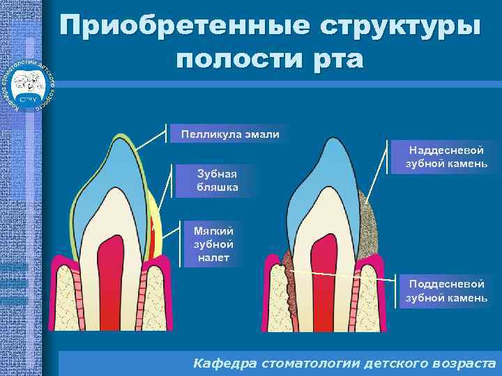 Зубная бляшка картинка