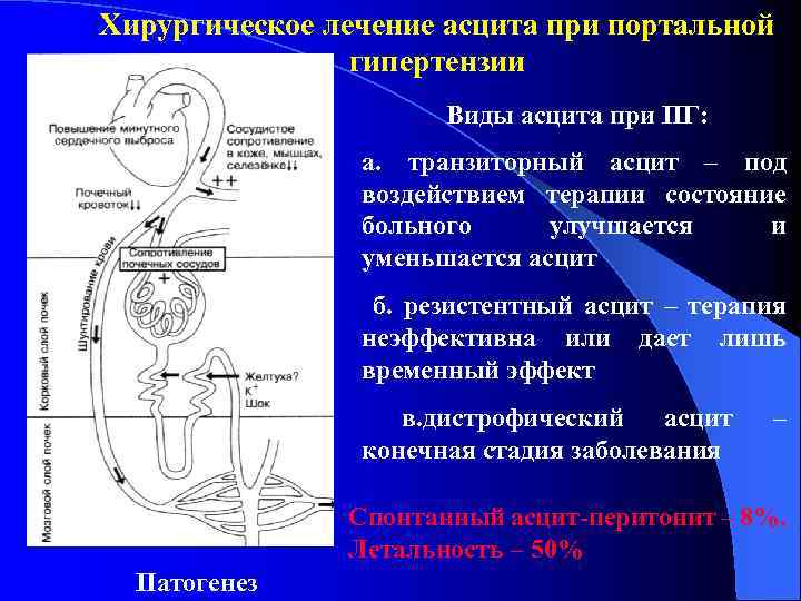 Хирургическое лечение асцита при портальной гипертензии Виды асцита при ПГ: а. транзиторный асцит –