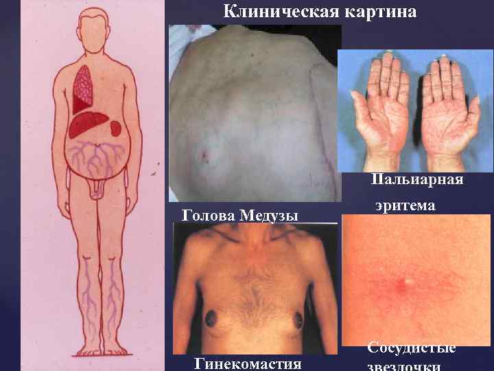 Клиническая картина Пальиарная Голова Медузы Гинекомастия эритема Сосудистые 