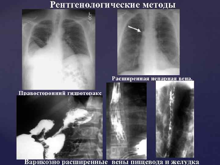 Рентгенологические методы Расширенная непарная вена. Правосторонний гидроторакс Варикозно расширенные вены пищевода и желудка 