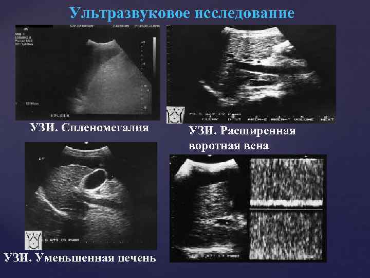 Ультразвуковое исследование УЗИ. Спленомегалия УЗИ. Уменьшенная печень УЗИ. Расширенная воротная вена 