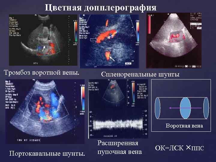 Цветная допплерография Тромбоз воротной вены. Спленоренальные шунты Воротная вена Портокавальные шунты. Расширенная пупочная вена
