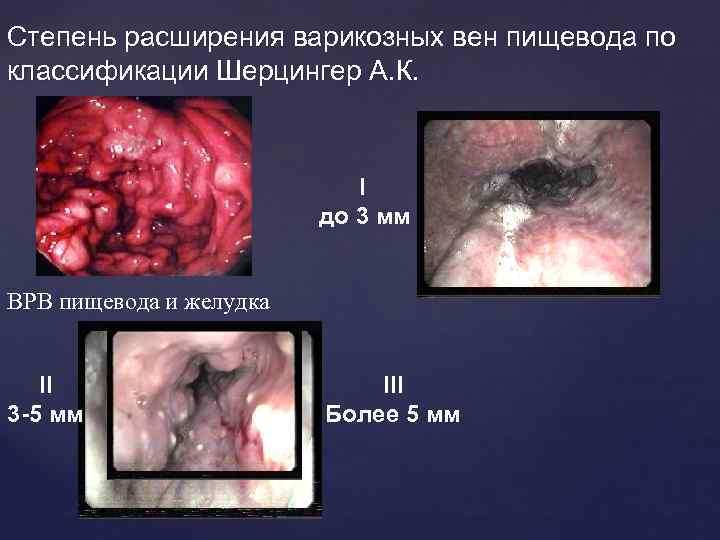 Степень расширения варикозных вен пищевода по классификации Шерцингер А. К. I до 3 мм