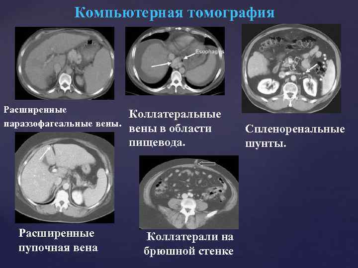Компьютерная томография Расширенные параэзофагеальные вены. Расширенные пупочная вена Коллатеральные вены в области пищевода. Коллатерали