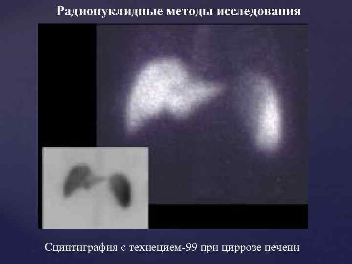 Радионуклидные методы исследования Сцинтиграфия с технецием-99 при циррозе печени 