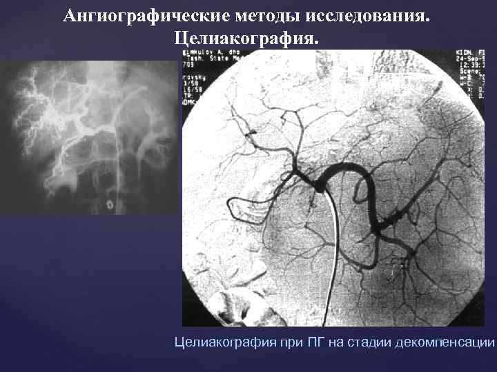 Ангиографические методы исследования. Целиакография при ПГ на стадии декомпенсации 