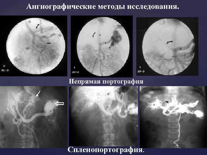 Ангиографические методы исследования. Непрямая портография Спленопортография. 