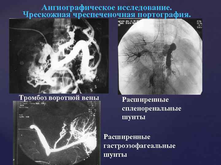 Ангиографическое исследование. Чрескожная чреспеченочная портография. Тромбоз воротной вены Расширенные спленоренальные шунты Расширенные гастроэзофагеальные шунты