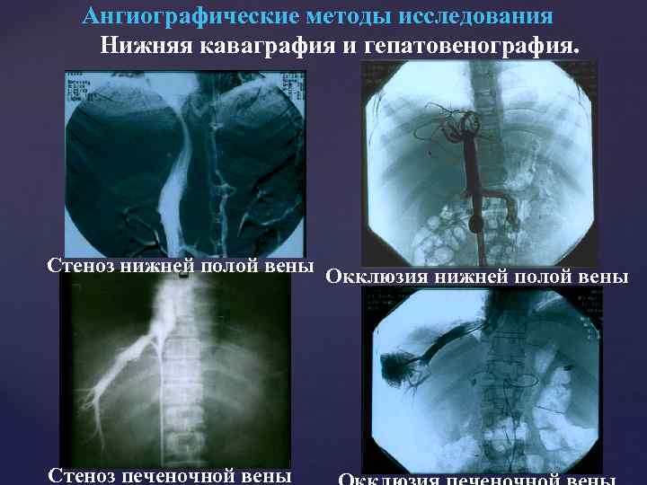 Ангиографические методы исследования Нижняя каваграфия и гепатовенография. Стеноз нижней полой вены Окклюзия нижней полой
