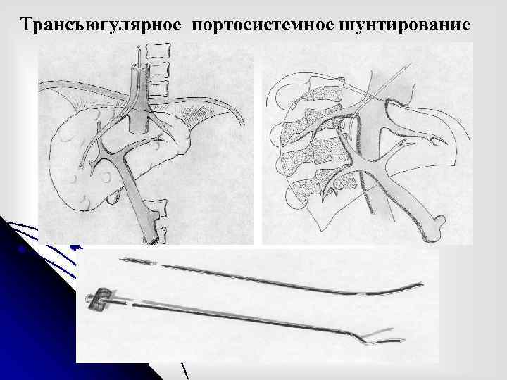 Трансъюгулярное портосистемное шунтирование 