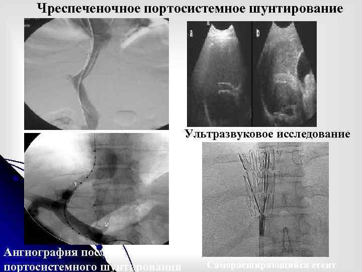 Чреспеченочное портосистемное шунтирование Ультразвуковое исследование Ангиография после портосистемного шунтирования Саморасширяющийся стент 