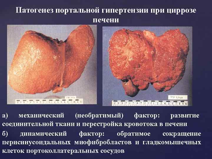 Патогенез портальной гипертензии при циррозе печени а) механический (необратимый) фактор: развитие соединительной ткани и