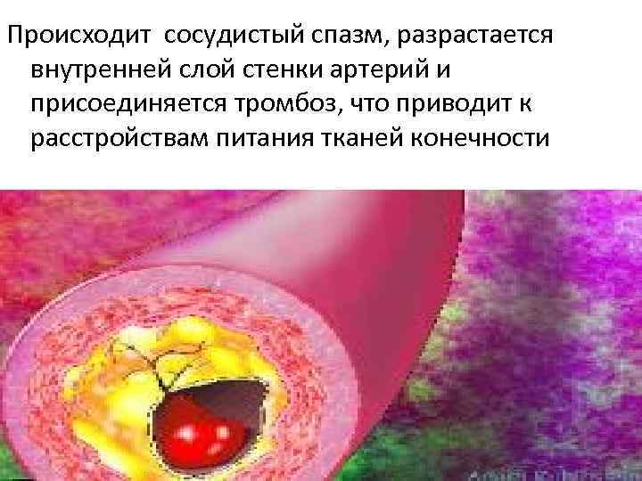 Происходит сосудистый спазм, разрастается внутренней слой стенки артерий и присоединяется тромбоз, что приводит к