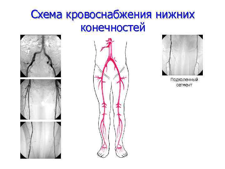 Моторная нейропатия нижних конечностей