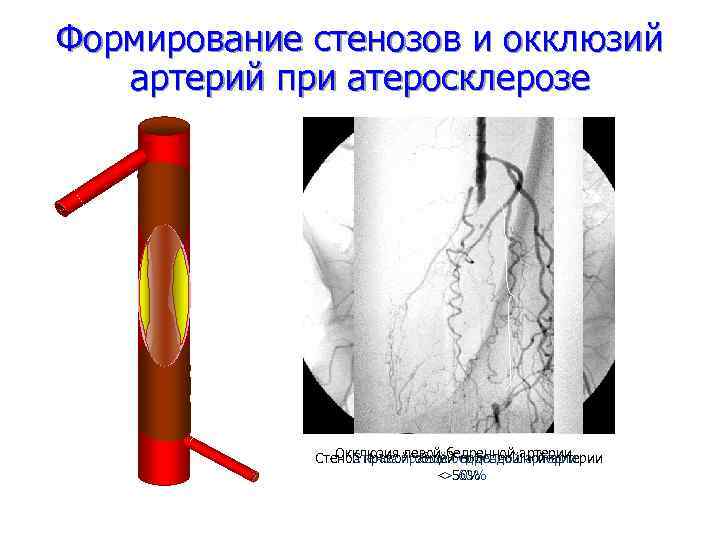 Схема тромбоза при атеросклерозе мозговых артерий