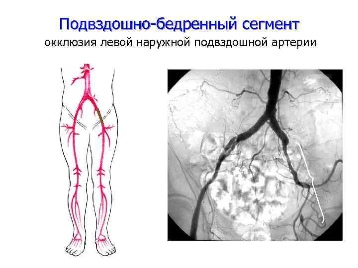 Подвздошная артерия где находится фото