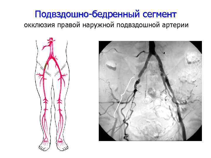Подвздошно-бедренный сегмент окклюзия правой наружной подвздошной артерии 