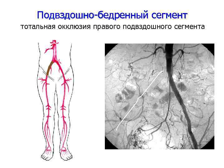 Подвздошно-бедренный сегмент тотальная окклюзия правого подвздошного сегмента 