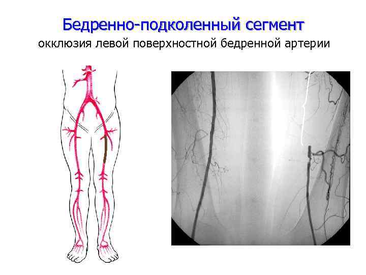 Бедренная артерия схема